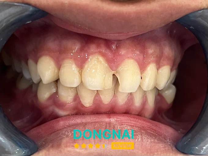 Nha khoa Bs Chung Uy Tin Chơn Thành - hình ảnh 3